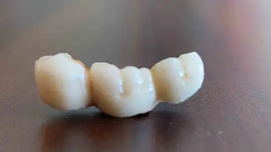 İmplant elinde hasta şikayette