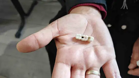 İmplant elinde hasta şikayette