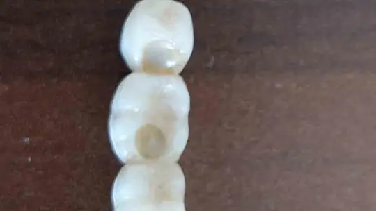 İmplant elinde hasta şikayette