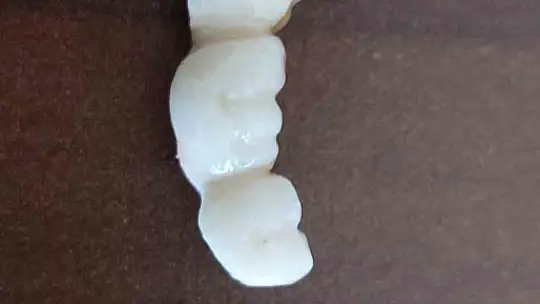 İmplant elinde hasta şikayette