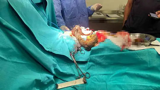 Kayseri'de 14 yaşındaki kızın midesinden 3.5 kilo saç kılı çıktı