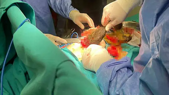 Kayseri'de 14 yaşındaki kızın midesinden 3.5 kilo saç kılı çıktı