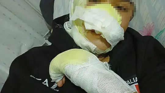 Kayseri'de fırında yanan çocuğa Bünyan Belediye Başkanı Metin'den destek