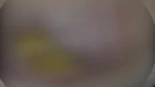 Yağ aldırma ameliyatı geçirdi hayatı karardı