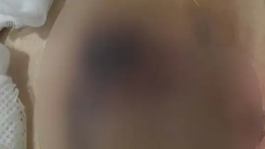 Yağ aldırma ameliyatı geçirdi hayatı karardı