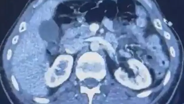 Ülkeye midelerinde uyuşturucu getiren şahıslar yakalandı