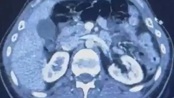 Ülkeye midelerinde uyuşturucu getiren şahıslar yakalandı