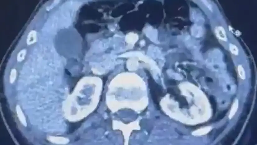 Ülkeye midelerinde uyuşturucu getiren şahıslar yakalandı